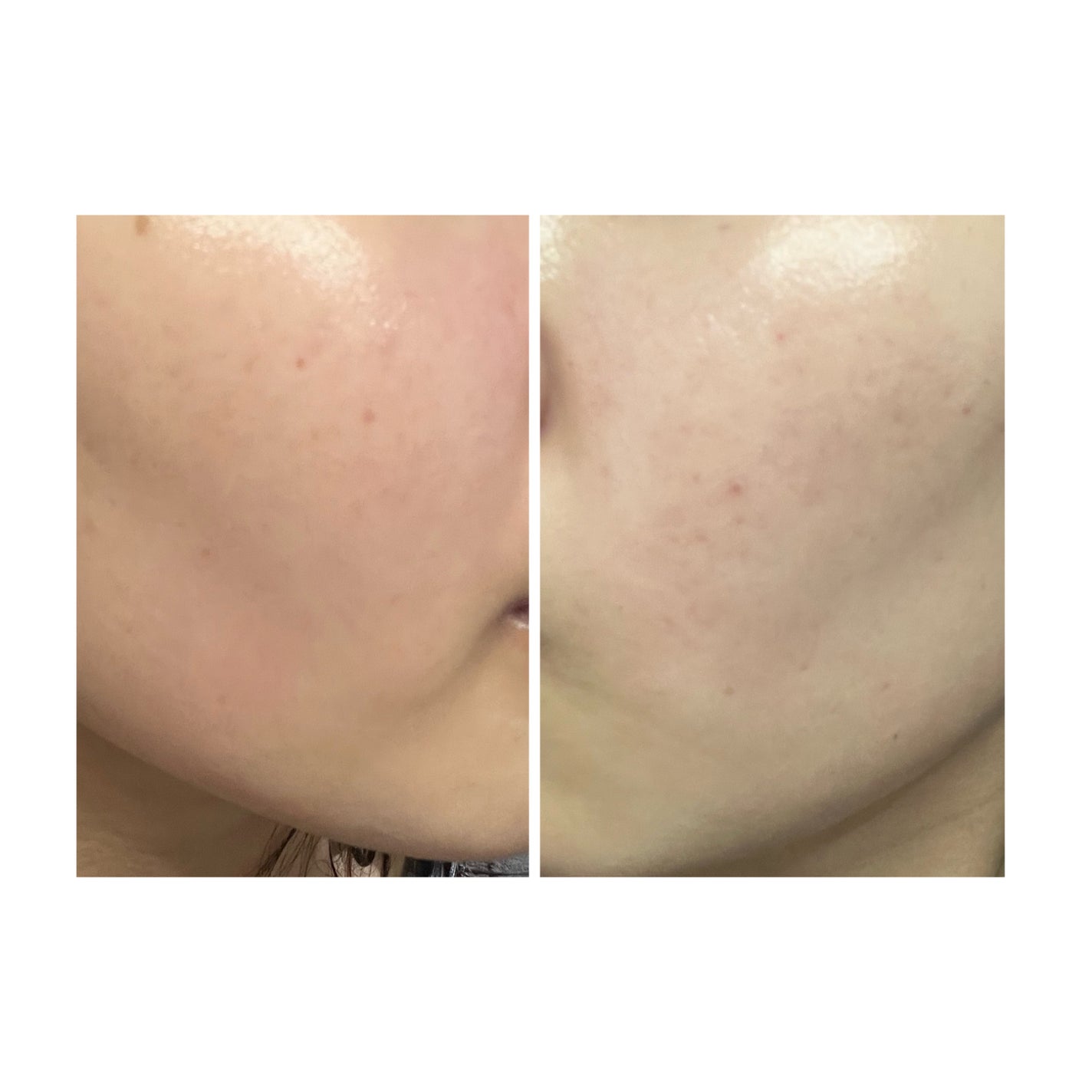 ぽむ on LIPS 「2023.9.13皮膚科に受診 エピデュオとヘパリン処方1枚目..」(4枚目)