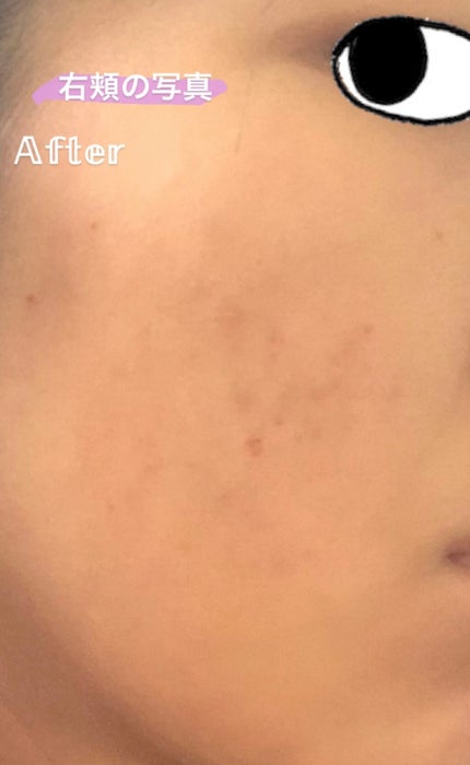 薬用 しみ 集中対策 美容液/メラノCC/美容液を使ったクチコミ(4枚目)