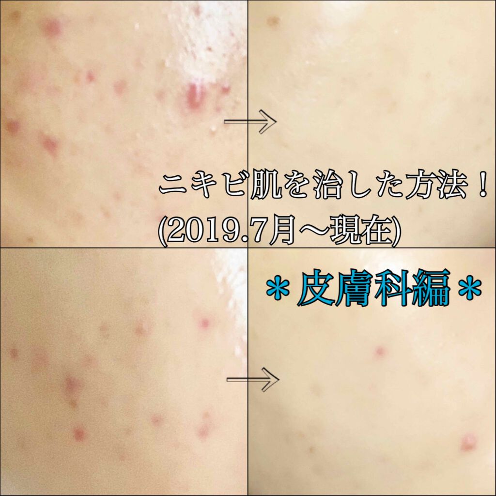 ベピオゲル/マルホ株式会社/その他を使ったクチコミ（1枚目）