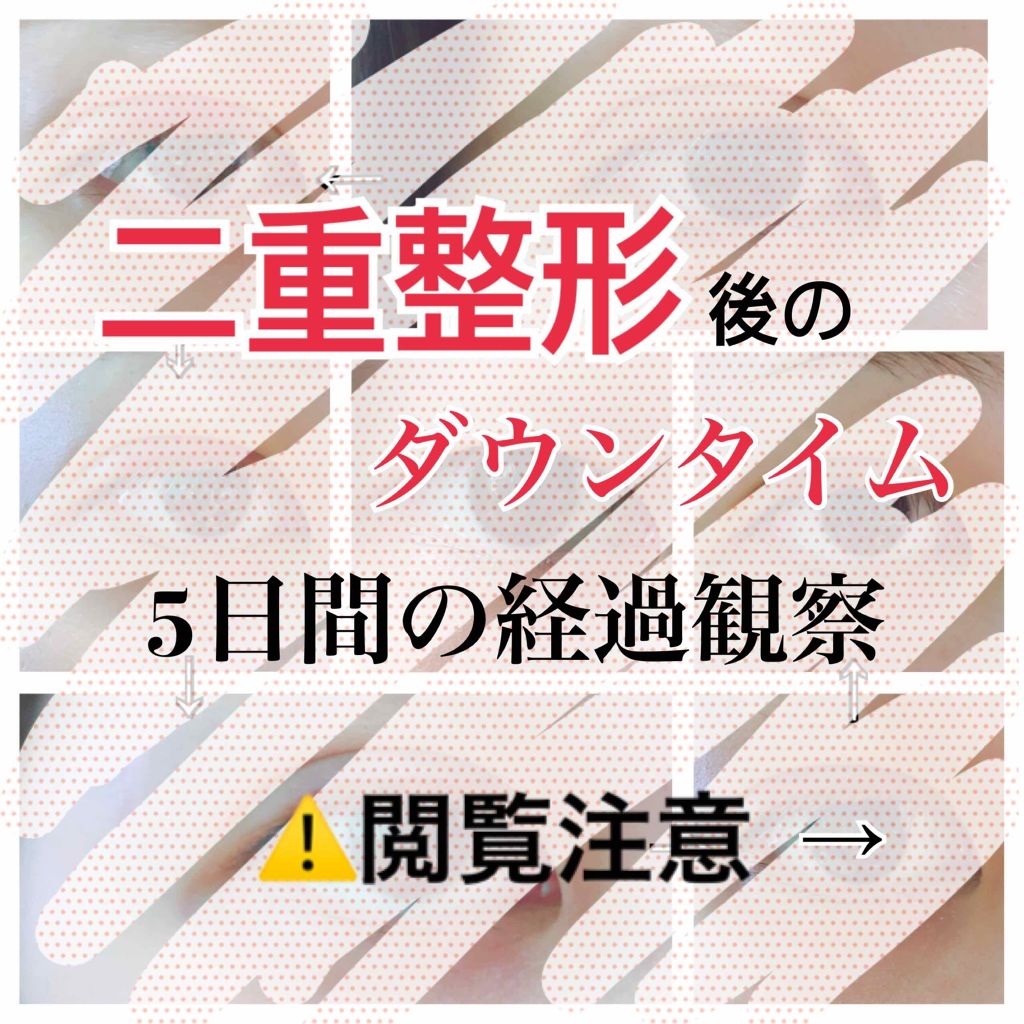 二重整形/その他を使ったクチコミ（1枚目）