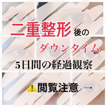 二重埋没手術をしてからのダウンタイムの様子です！！

⚠️2枚目閲覧注意！目いっぱい出てきます。


施術した当日から5日間、写真に撮って経過観察しました！！


施術した当日は内出血してなかったのに、