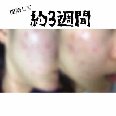 ⚠️汚肌の画像があります⚠️

LIPSに投稿し始めて約3週間経ちました👌



、、、なかなか良くなってくれません😭



前回の投稿から変わったことは、

・クリアクネアを飲むのをやめた
・ペアアク