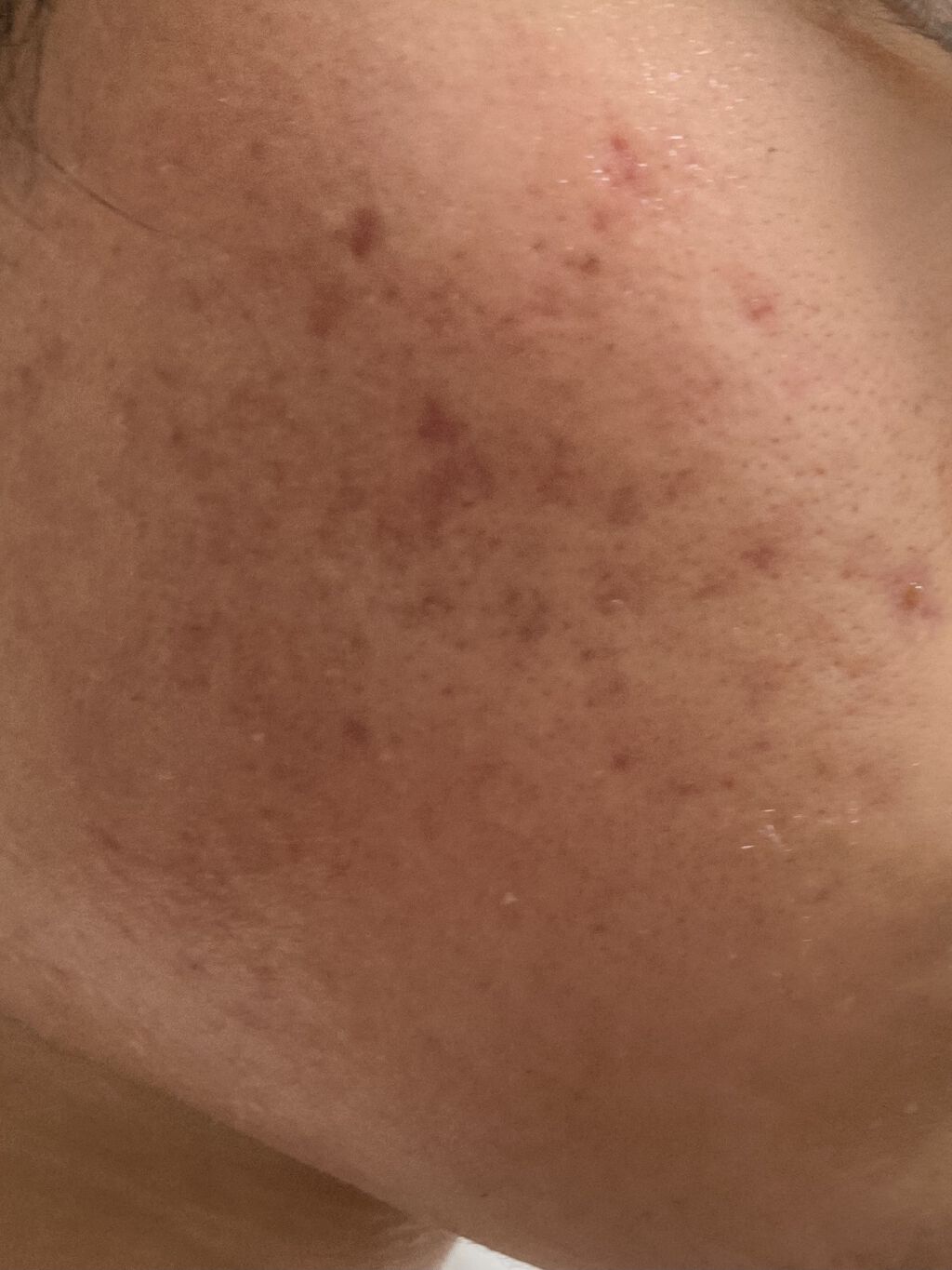 エピデュオゲル/マルホ株式会社/その他を使ったクチコミ（2枚目）