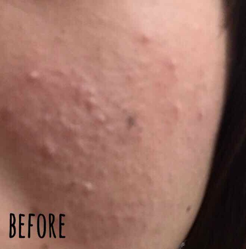 ロゼット洗顔パスタ アクネクリア/ロゼット/洗顔フォームを使ったクチコミ（3枚目）