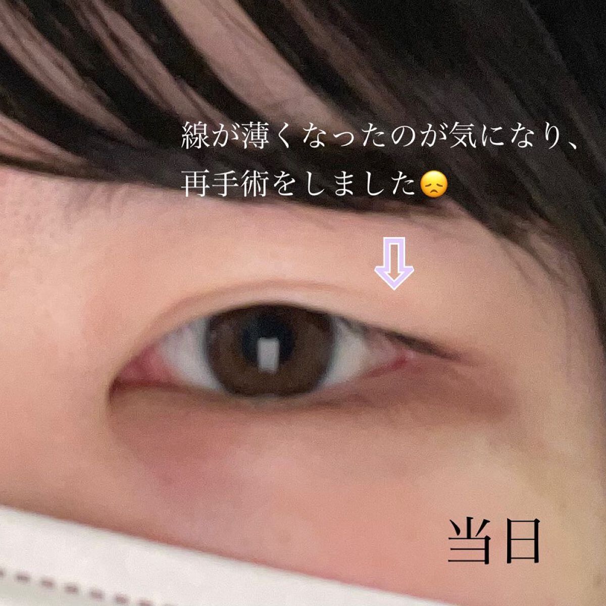 すぅ on LIPS 「私は、4年前から少しずつプチ整形も含めて、整形しています!20..」(2枚目)