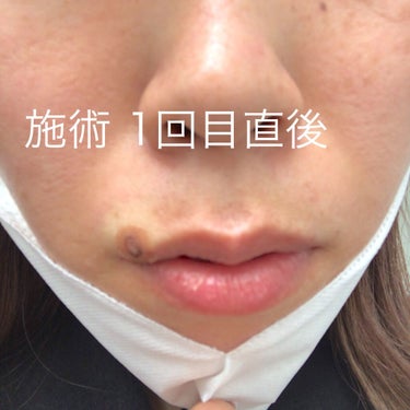 MOCA on LIPS 「【ホクロ除去体験】垢抜けには必須！＊個人の体験になりますので全..」（3枚目）