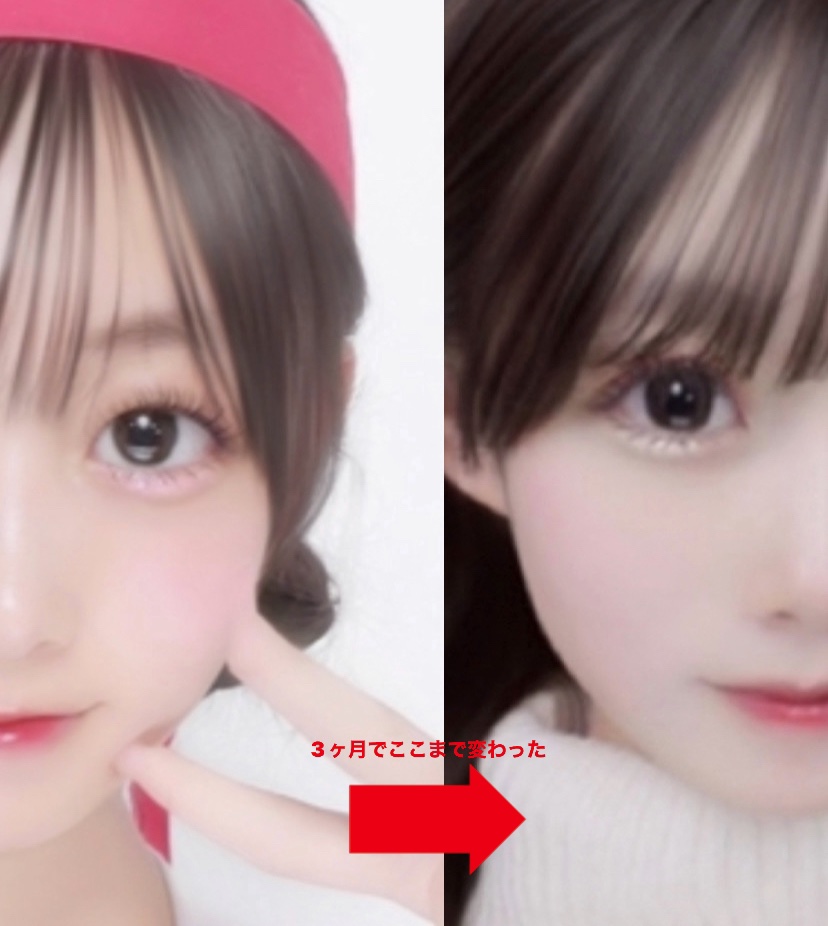 のびーるアイテープ（絆創膏タイプ、レギュラー）/DAISO/二重まぶた用アイテムを使ったクチコミ（1枚目）