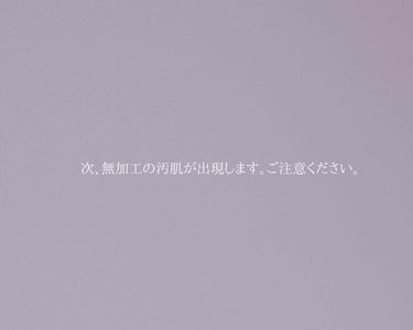 2回目の投稿で、恥を捨てて自分の汚肌を投稿します。(写真は今の現状です。)
無駄話もするのでよければ聞いてください🙇‍♂️

昨年、2019年12月22日。
私は東京に旅立ちました。
なぜなら、そう。
大好きなあの5人組、嵐さんを拝むべく!!!!!

しかし、12月16日の週から私はホルモンバランスの乱れによって、肌は薄皮がベロベロになり、ニキビもでっかいのが5つ程、しまいにはヘルペスが出来てしまい、もう絶望の淵に立たされていました。

急いでドラックストアに行き、効くのか分からない美容ドリンクを2本、リジンの含まれたサプリメント、にきびパッチ、以前使っていたニキビ用の洗顔を買い、自分でメンテナンスをし始めました。

そして、東京出発の日、にきびとヘルペスは撲滅することに成功しました。

やった！と思ったのも束の間、鏡を見ると忘れていた存在・薄皮とずっと私を悩ませている毛穴。

久しぶりに出来たニキビとヘルペスに気を取られ、忘れていたのです。

東京にたどり着き、観光をしつつ見つけたLOFTに行き、TSURURIと出会いました。

｢このこは、YouTubeでも度々紹介されてるやつではなかろうか！！｣

即購入、ホテルに帰り、シャワーを浴び、寝る準備をして、使いました。


結果として、効果はイマイチ分かりません。
そりゃそうじゃ。1日で効果が見られるスーパーアイテムがあったら、みんな買ってるよね。（薄皮に関しては、TSURURIさん専門外なんじゃ…？）

…でも、洗い流したあとはもっちりしてるし、肌のトーンも上がったような……？

そして、これを塗ったあとの顔が母親お墨付きなようで、写真撮影なんかもして、いい思い出になりましたなと。

そんな感想を抱きつつ、次の日ライブに行って、しっかり泣いて、その次の日に東京を後にしました。


それから、週に2、3回使っての結果。
母親に｢毛穴綺麗になってるない？｣って言われました(°▽°)

うっそん！ってなりました。
自分的には完璧を追い求めすぎてて、気づかなかったんですけど、確かに前よりも毛穴が目立っていないなって！


こりゃあ、諦めずに使い続けてみよう！と思います。

他にも、これは毛穴消せるよ！ってものがあれば教えてください。お願いします！

今、ピーリング機能のある美顔器なんかにも手を伸ばそうとしております(＾ω＾)


(あっ、因みに薄皮は遅れていた月一のものが来てすぐ消え去りました‎( ꒪⌓꒪))


長い文章最後まで読んでくださった方、ありがとうございました！！！


 #みんなに質問 
#黒ずみ毛穴 
#汚肌
の画像 その1