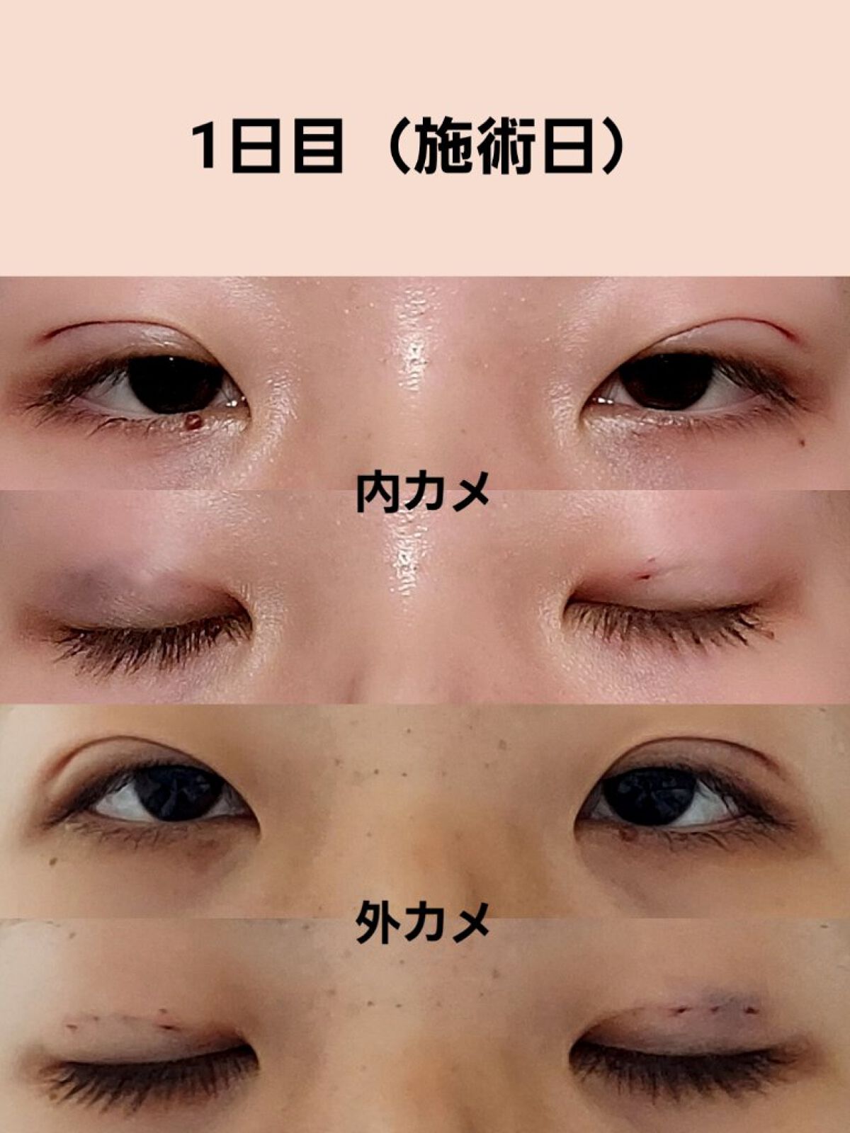 のびーるアイテープ（絆創膏タイプ、レギュラー）/DAISO/二重まぶた用アイテムを使ったクチコミ（3枚目）