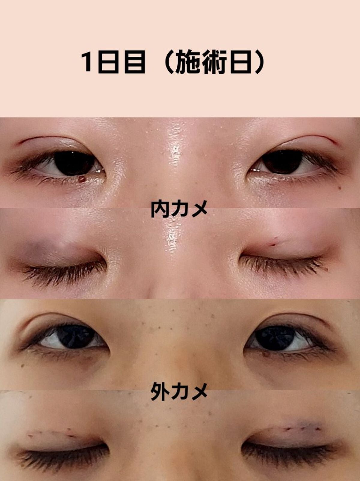 のびーるアイテープ(絆創膏タイプ、レギュラー)/DAISO/二重まぶた用アイテムを使ったクチコミ(3枚目)