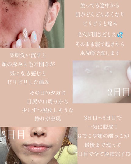 ダーマスキンピーリング/BQCELL/その他キットセットを使ったクチコミ(4枚目)