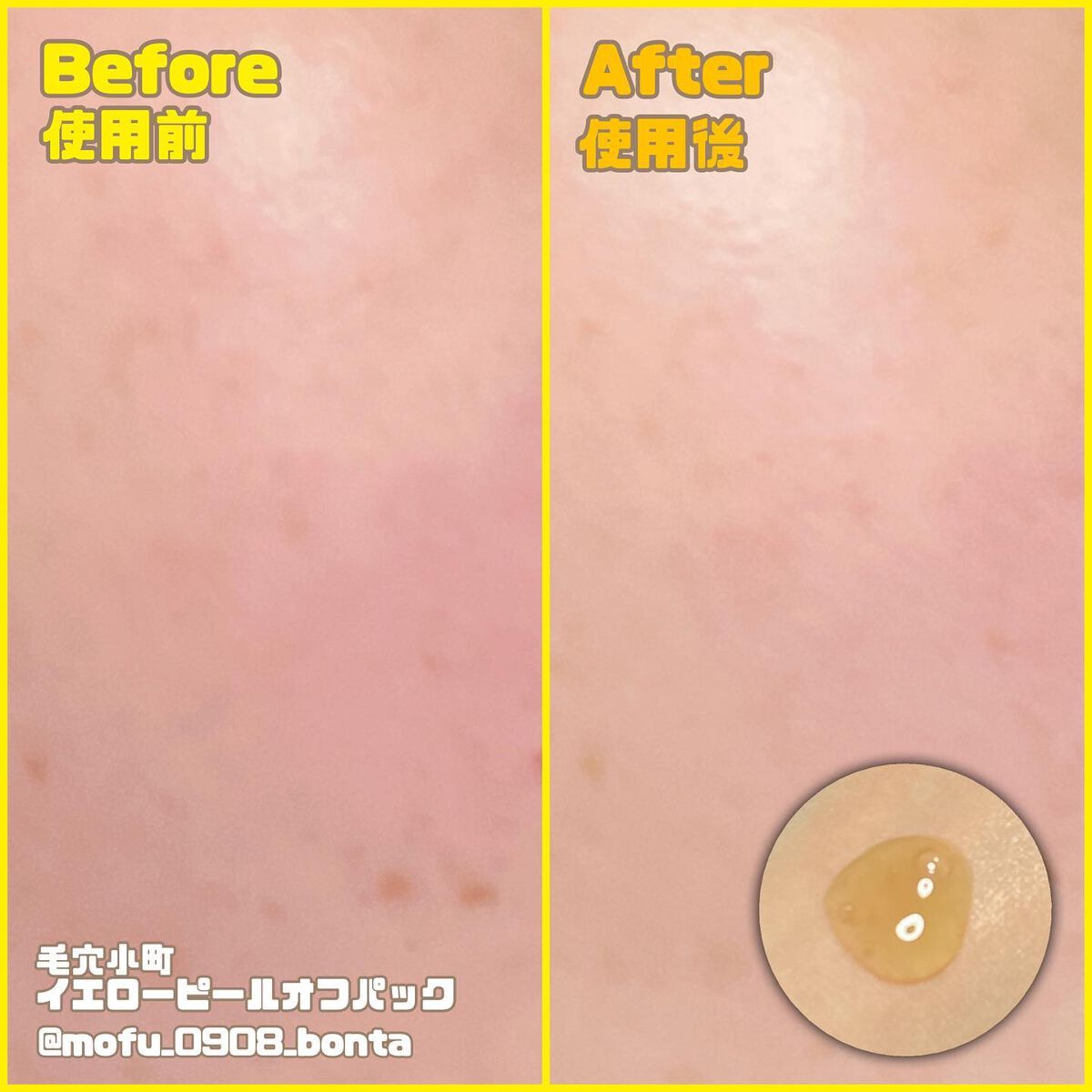 毛穴小町 ブラックピールオフパック/クリアターン/ピーリングを使ったクチコミ(4枚目)