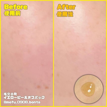 毛穴小町 ブラックピールオフパック/クリアターン/ピーリングを使ったクチコミ(4枚目)