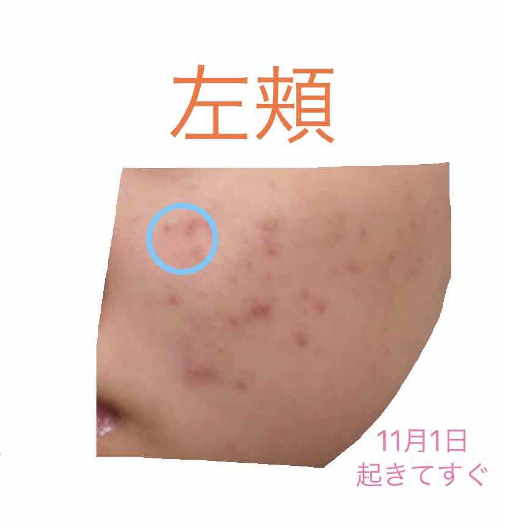 薬用 しみ 集中対策 美容液/メラノCC/美容液を使ったクチコミ(4枚目)