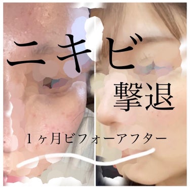 ＼定期的にニキビ大爆発する私の対処法／

特別肌が弱いって訳でもないと思うんですが
合わない化粧品を使ったり、
合わないスキンケアに変えたりすると、
2~3日程で急にニキビまみれになります🔥

もうこう