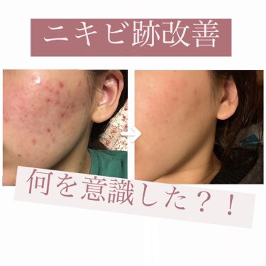 サンホワイトシルキー Y 1 サンホワイトの口コミ ニキビを治すために 何を意識した By Yuyu フォロバ強化中 混合肌 代後半 Lips