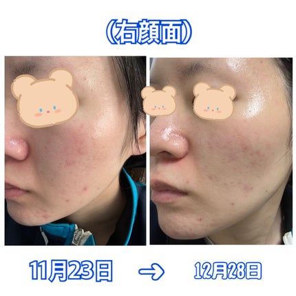 レチノール0.3 ナイアシンリニューイングセラム/Anua/美容液を使ったクチコミ(6枚目)