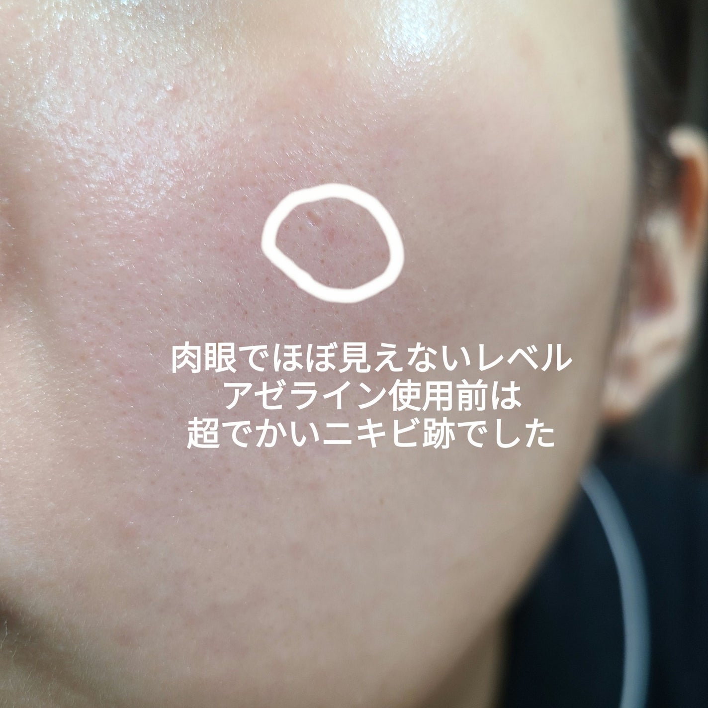 ダーマセプトRX AZAセラム/ダーマセプトRX/美容液を使ったクチコミ(2枚目)