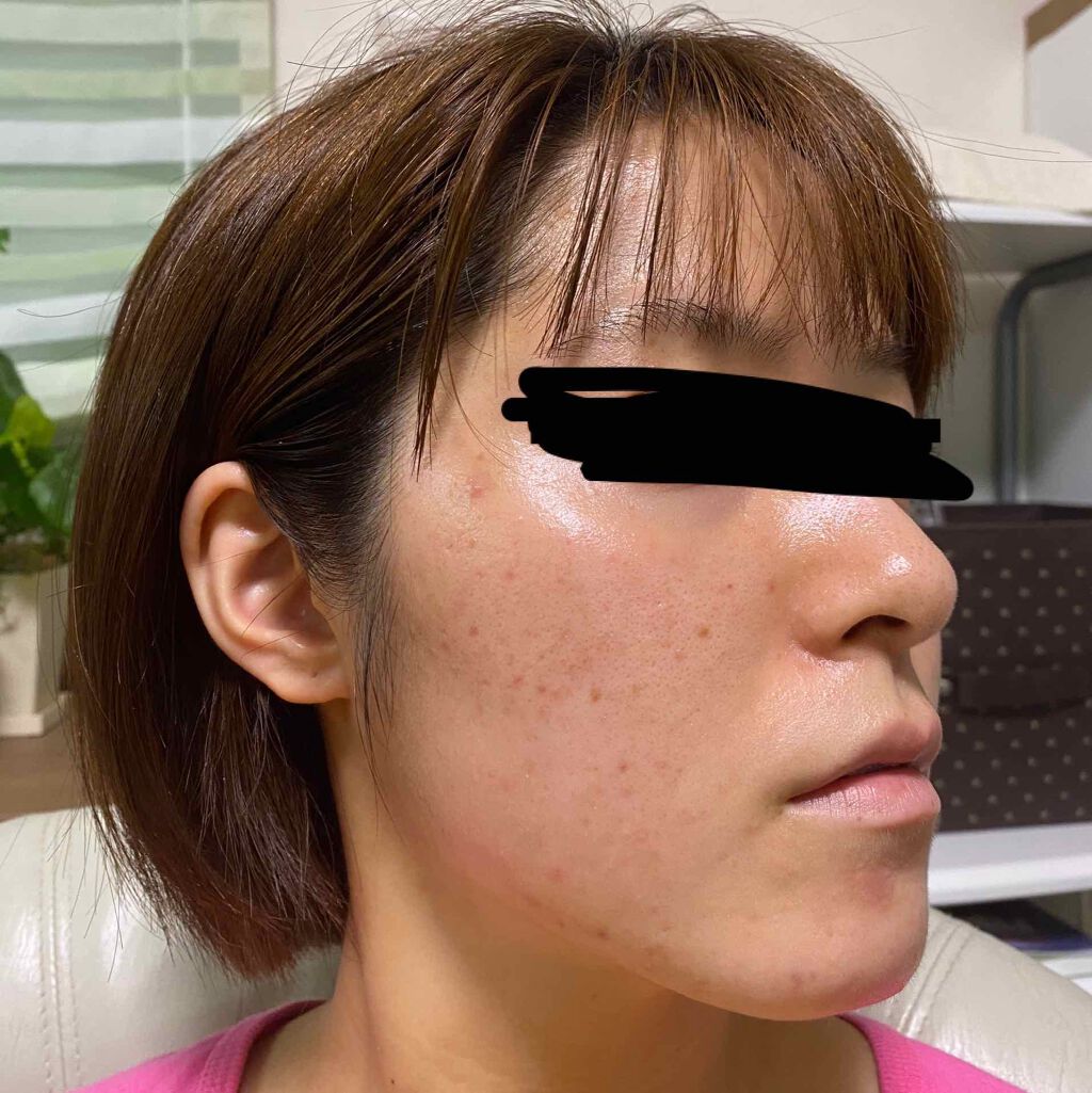 pink_beauty_a6u on LIPS 「下からとったからめちゃ顎でてるけど(笑)昨日皮膚科でニキビ潰し..」(4枚目)