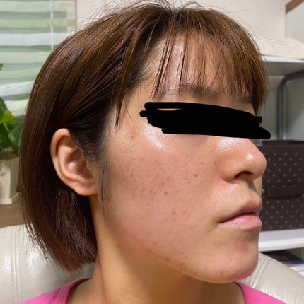 pink_beauty_a6u on LIPS 「下からとったからめちゃ顎でてるけど(笑)昨日皮膚科でニキビ潰し..」(4枚目)