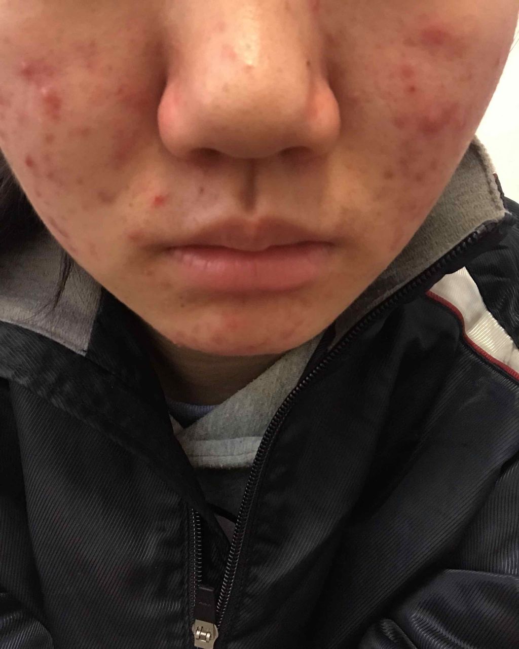 ずみこ on LIPS 「#ニキビ日記また酷くなってきたかなあ実は、昨日から造顔マッサー..」(2枚目)