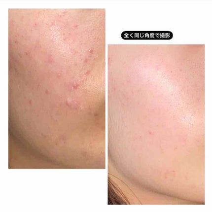 ノブ A アクネソープ/NOV/洗顔石鹸を使ったクチコミ(2枚目)