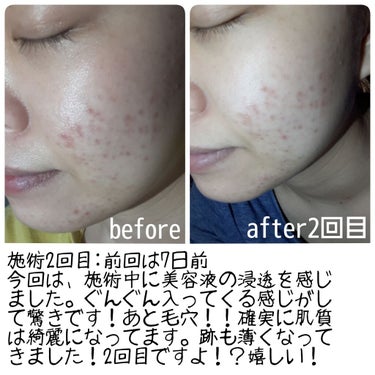 ほたて on LIPS 「こんにちは、ほたてです🌱先週の土曜日、初ハーブピーリングを体験..」（3枚目）