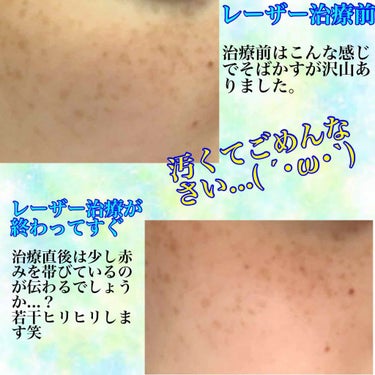 れいな💫フォロバ100.% on LIPS 「こんにちは！今回は先日お話しましたシミ、そばかす、毛穴に効くレ..」（2枚目）