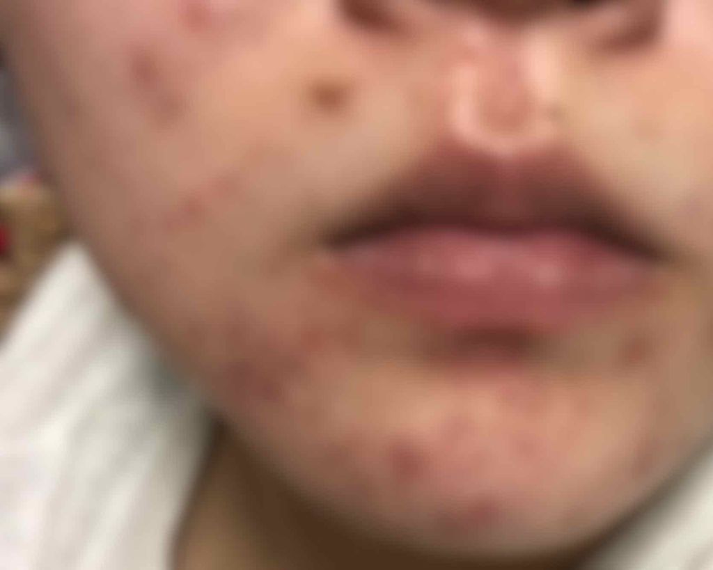 まるこ on LIPS 「肌が最高にやばい。過去最悪。生きたくない。人に会いたくない。化..」(2枚目)