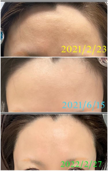 Rodan and Fields ディファイン AMP MD システムのクチコミ「Rodan and Fields
ディファイン AMP MD システム

私の最大の悩みのひと.....」（3枚目）