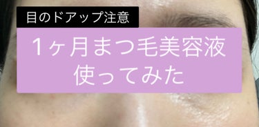 ↓以前の投稿と比較できます。
https://lipscosme.com/posts/5064645

産毛のような細いまつ毛しかなく、禿げていた目尻、上瞼の炎症で禿げた部分が…
目立たないくらいには、しっかりとしたまつ毛が生えて来ました🥰

新しく毛が生えてくることはなかったのですが、効果は実感できました！

#まつ毛美容液
#rom&nd
の画像 その0