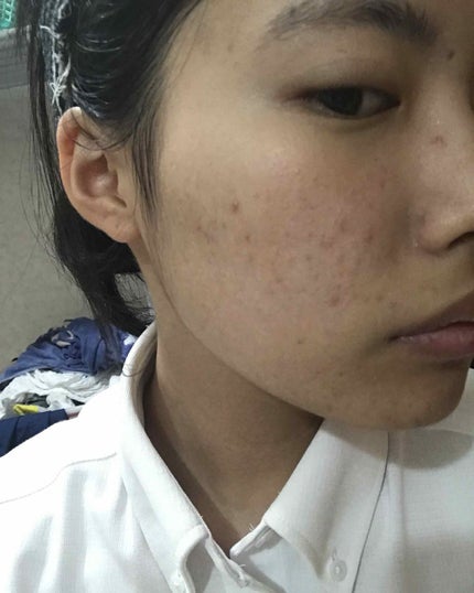 NARIMI on LIPS 「夏はニキビが増える時期ですよね〜。まず1枚目が現在2枚目が昔💦..」(4枚目)