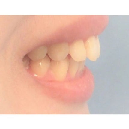 みとらん on LIPS 「さてさて、わたくし、アラフォーにして歯科矯正を始めました。今回..」(5枚目)