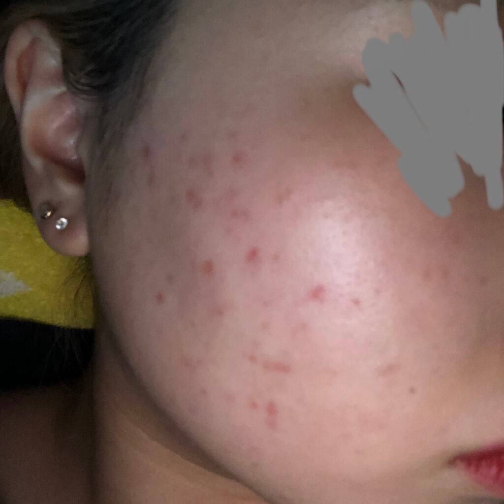 coral_beauty_0cj on LIPS 「中学生の頃くらいからニキビに悩まされていて、大学生になった今で..」(2枚目)