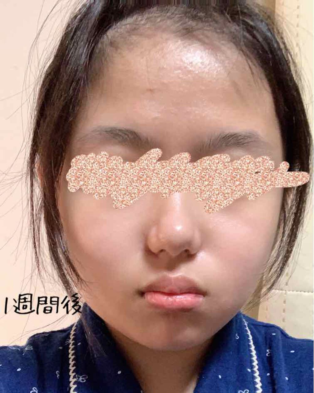 薬用クリア化粧水/メンソレータム アクネス/化粧水を使ったクチコミ（3枚目）