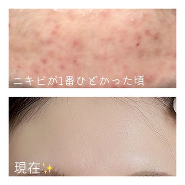 メラノCC 薬用しみ対策 美白化粧水のクチコミ「＼ニキビだらけだった私がニキビゼロ／
美肌のためにやっていること

✼••┈┈┈┈┈┈┈┈┈┈.....」（2枚目）