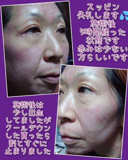 瞳子うさぎ@定期的に投稿ある方フォロバ on LIPS 「今まで埋没二重術や、糸リフトなど美容医療を経験してきましたが、..」(2枚目)