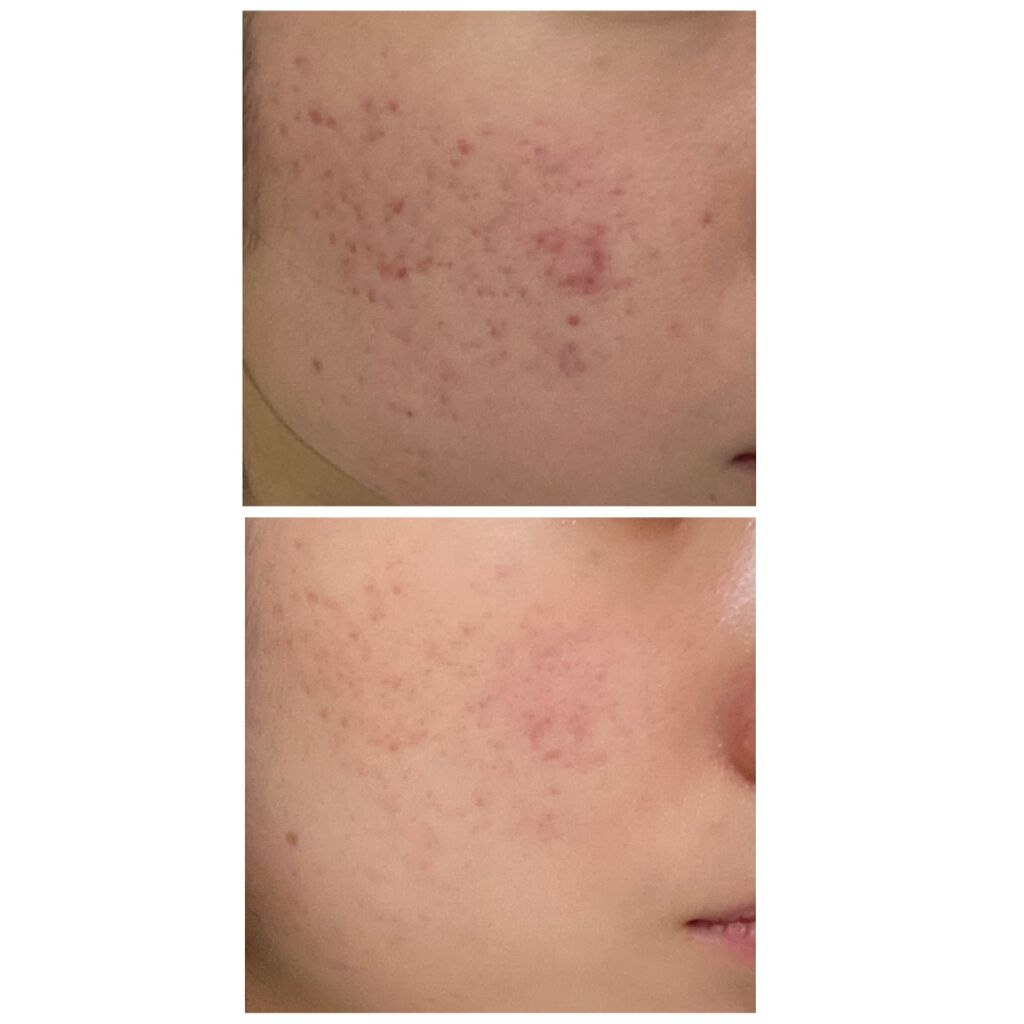 01_ringo_01 on LIPS 「上の写真が1日目、下の写真が薬を塗り始めて82日目💊もう少しで..」(2枚目)