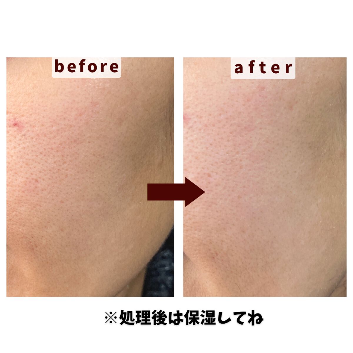 サロンプラス トーンアップ フェイススムーサー ホルダー（刃付き）/サロンプラス/シェーバーを使ったクチコミ（2枚目）