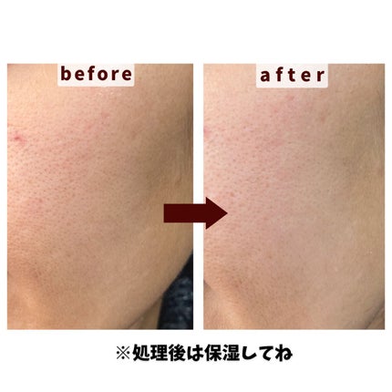 サロンプラス トーンアップ フェイススムーサー ホルダー(刃付き)/サロンプラス/シェーバーを使ったクチコミ(2枚目)