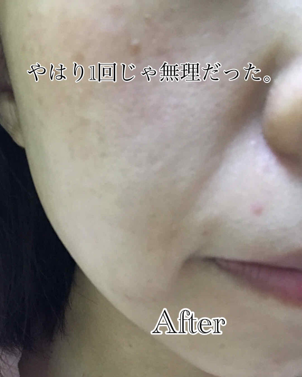 ティーツリーケア ソリューション エッセンシャルマスクEX/MEDIHEAL/シートマスク・パックを使ったクチコミ（3枚目）