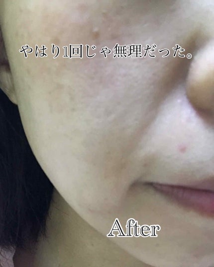 ティーツリーケア ソリューション エッセンシャルマスクEX/MEDIHEAL/シートマスク・パックを使ったクチコミ(3枚目)