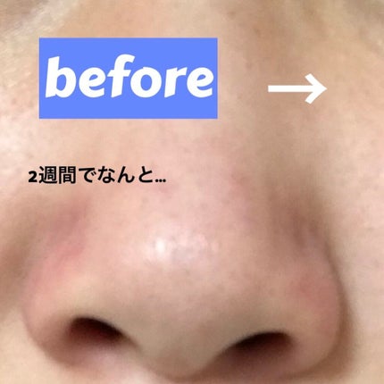 mio on LIPS 「2週間で鼻を高く、小さくする方法👼(個人差があります🤧)⚠️⚠..」(1枚目)