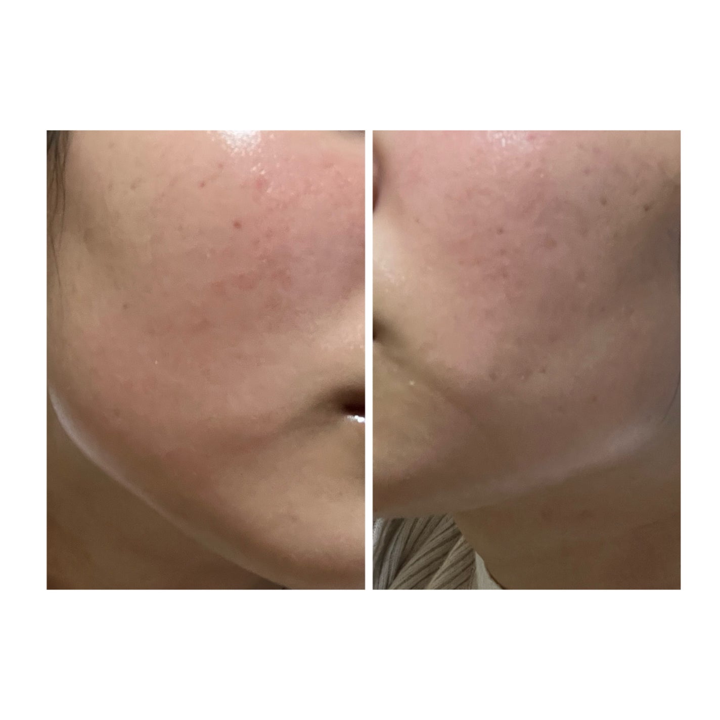 ぽむ on LIPS 「2023.9.13皮膚科に受診 エピデュオとヘパリン処方1枚目..」(5枚目)