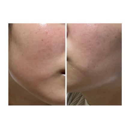 ぽむ on LIPS 「2023.9.13皮膚科に受診 エピデュオとヘパリン処方1枚目..」(5枚目)