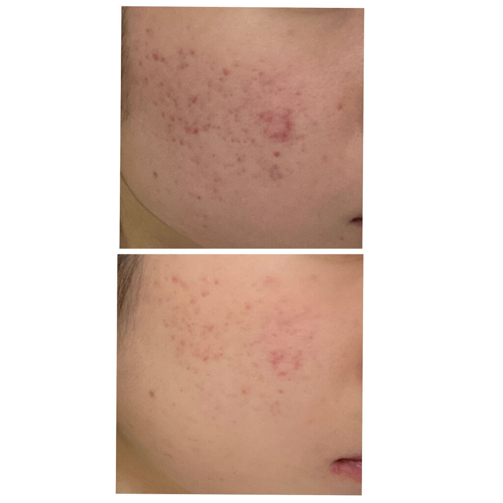 ベピオゲル/マルホ株式会社/その他を使ったクチコミ（2枚目）