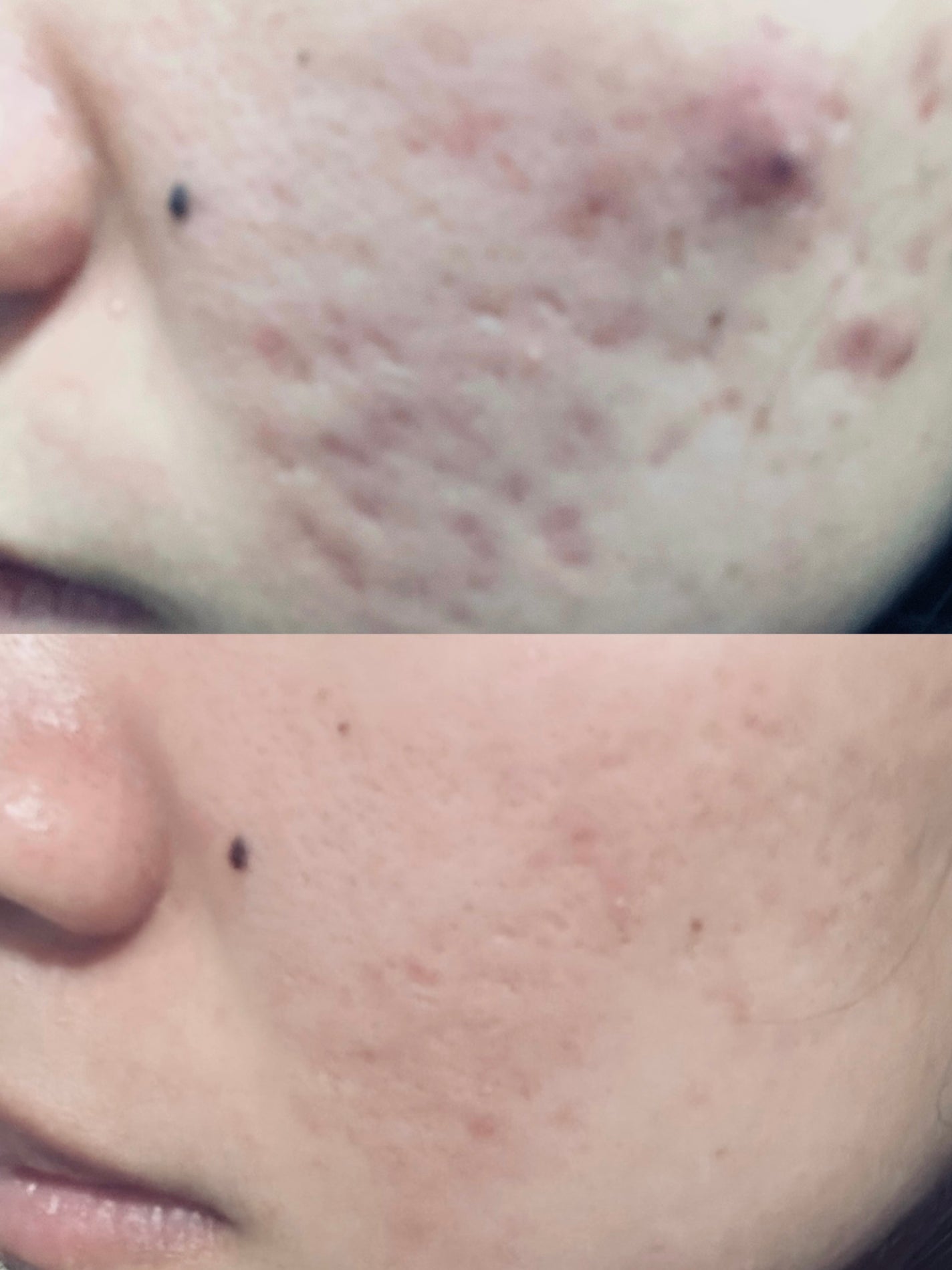 トリア・スキン エイジングケアレーザー/トリア/美顔器・マッサージを使ったクチコミ(2枚目)