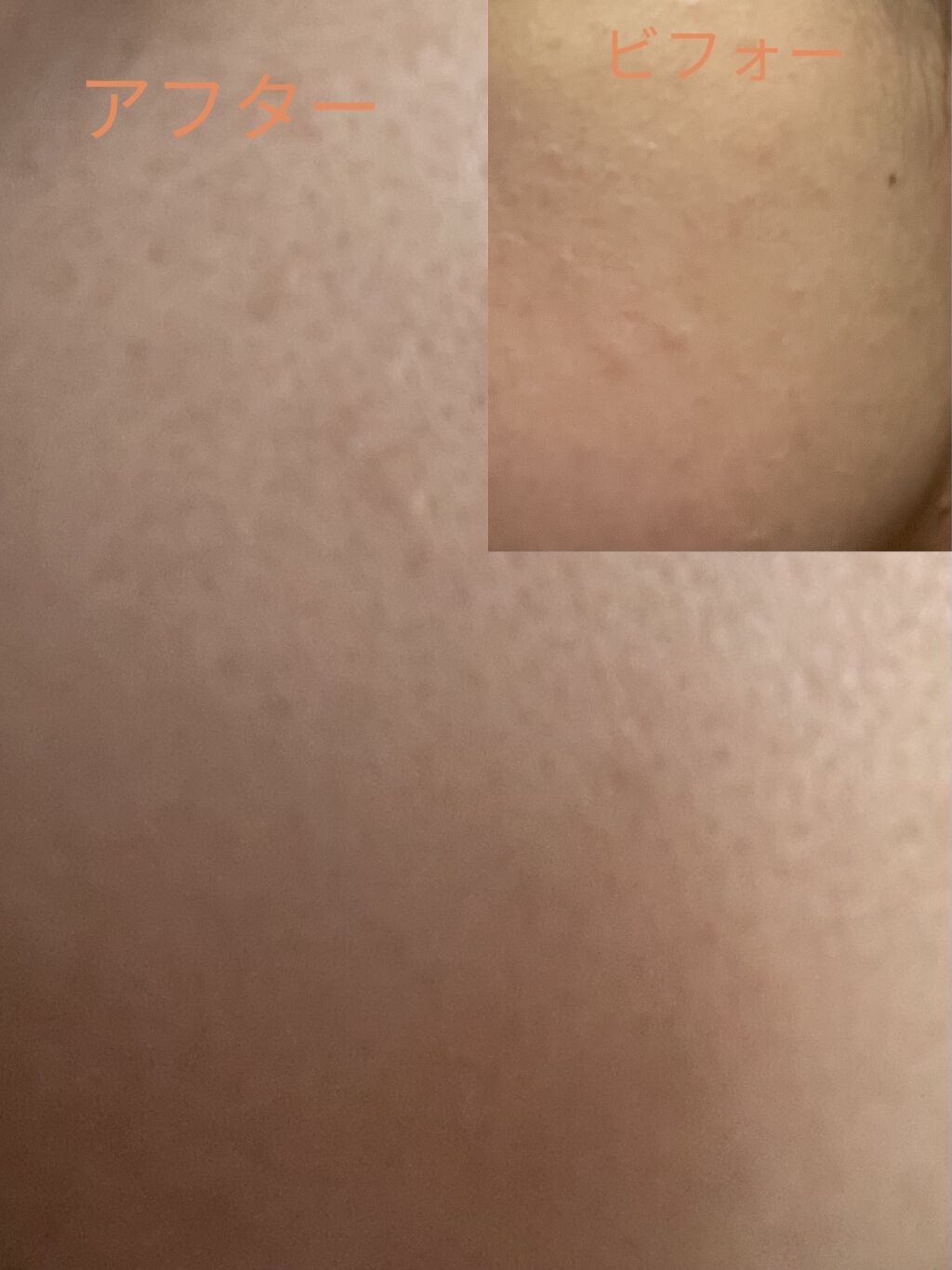 加工ナシ！ここまで良くなりました(^^)
加工ナシの為汚い肌ですいません(^_^;)
でもこれでも良くなった方です(^^)

ネイチャーリパブリック　
グリーンダーママイルドシカビックトナー　
グリーンダーママイルドクリーム

この2つで1