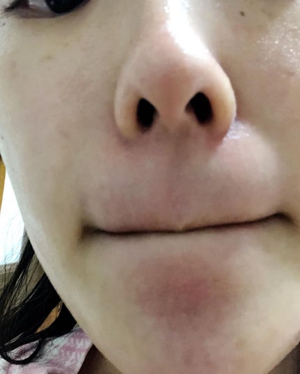 アカルミー化粧水/ワイズ/化粧水を使ったクチコミ(2枚目)