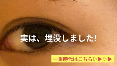 ぽむ🍮混合肌、毛穴ケア、彼氏ウケメイク on LIPS 「【ご報告】埋没しました👀✨皆さんお久しぶりです、ぽむです✨実は..」（1枚目）